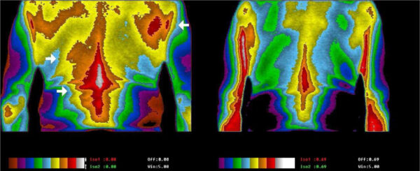 thermal imaging showing back pain improvement 